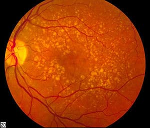 Age-Related Macular Degeneration (AMD)