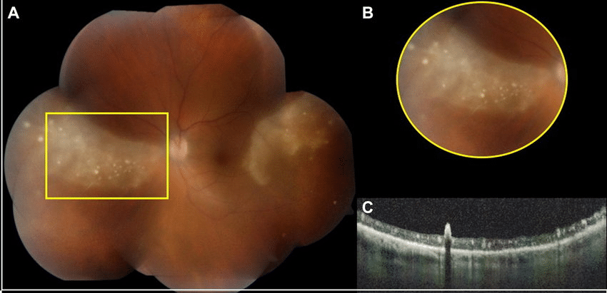 Multimodal imaging patterns of posterior syphilitic uveitis: a review of the literature, laboratory evaluation and treatment