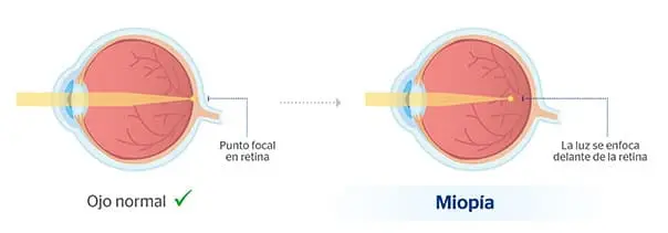 Por que cada vez hay mas miopia infantil?