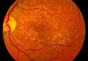 300px-Intermediate_age_related_macular_degeneration