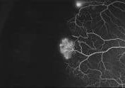 Sickle cell retinopathy